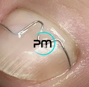 Сложная ортониксия 2 podomama.by