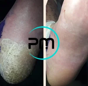 Педикюр подологический пп3.1