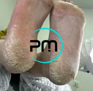 Педикюр подологический пп4