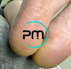 Педикюр подологический пп5