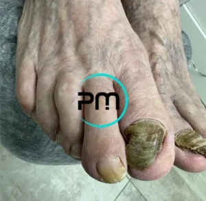 Обработка утолщенных и деформированных ногтей 1 podomama.by