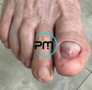 Обработка утолщенных и деформированных ногтей 2 podomama.by