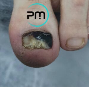 chorobow paznokci podomama.pl