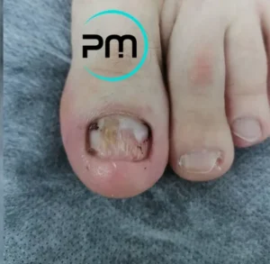 Обработка утолщенных и деформированных ногтей podomama.by