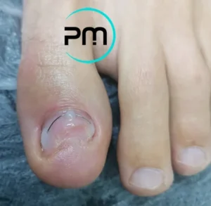 установка корректирующей системы титановая нить podomama.by