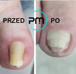 установка корректирующей системы титановая нить podomama.by до и после