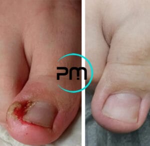 Вросший ноготь podomama.by