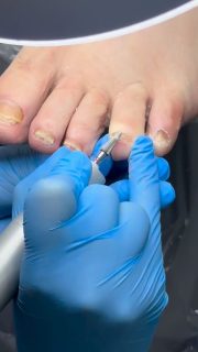 Зачистка пораженного ногтя у подолога — это не альтернатива лечению, это его обязательная и самая важная первая стадия.Можно годами использовать самые современные и дорогие препараты, но если они не достигают цели, вы просто тратите время, деньги и нервы, наблюдая, как грибок захватывает все новые территории.Задача подолога - не просто «сделать красиво». Наша задача — создать все условия для того, чтобы назначенная врачом терапия сработала на 100% и привела вас к здоровым и крепким ногтям в максимально короткие сроки.Готовы наконец-то подойти к решению проблемы системно?Запишитесь на консультацию - вместе составим четкий и работающий план действий.
Отправить сообщение в директ или позвонить по 📞+375296722200#podologminsk#подологвминске